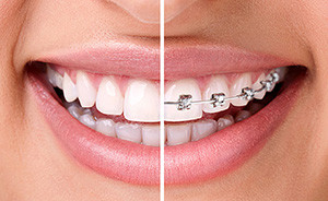 치아 교정기 - Orthodontic