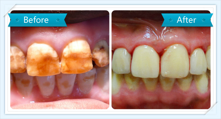 tooth veneers