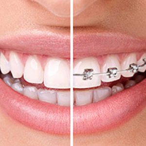 치아 교정기 - 언어 중괄호, 이전과 이후