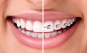 dental braces - lingual braces, before and after