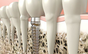 Dental implants