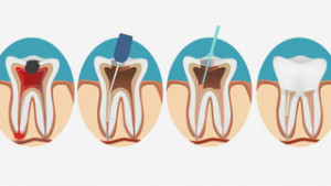 Root_Canal_Therapy