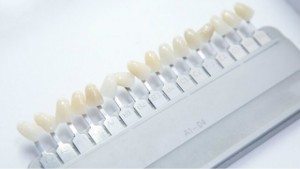 TOOTH-VENEERS