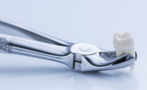 Teeth_Extraction-3