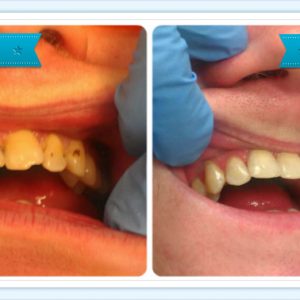 Tooth Veneers – Smile Dental Ranui – Dr. Ala Al-Attar