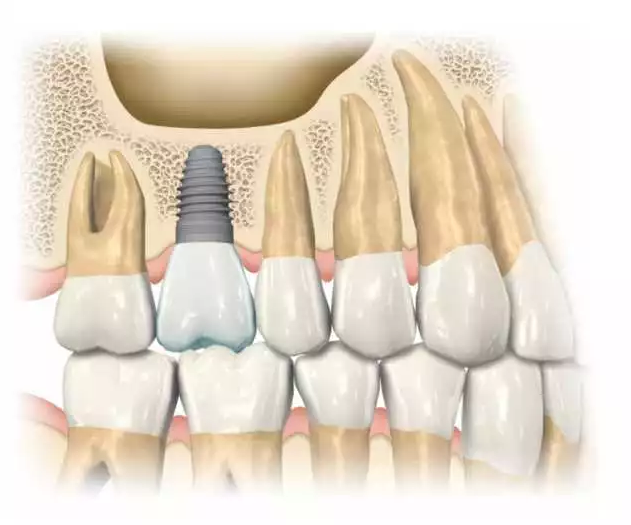 implants_2