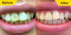 smile-dental-case-dr.Teresa Leung01