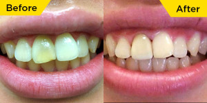 Smile-dental-case-dr.Teresa Leung01