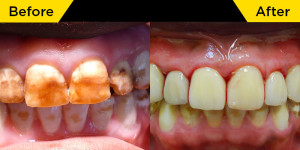 Smile-dental-case-dr.Teresa Leung02