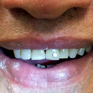 smile-dental-case-dr.Teresa Leung03