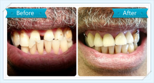 tooth-veneers-smile-dental-takanini-dr-teresa-leung