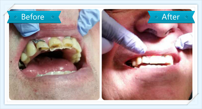 filling_veneer_dentist_Alttra