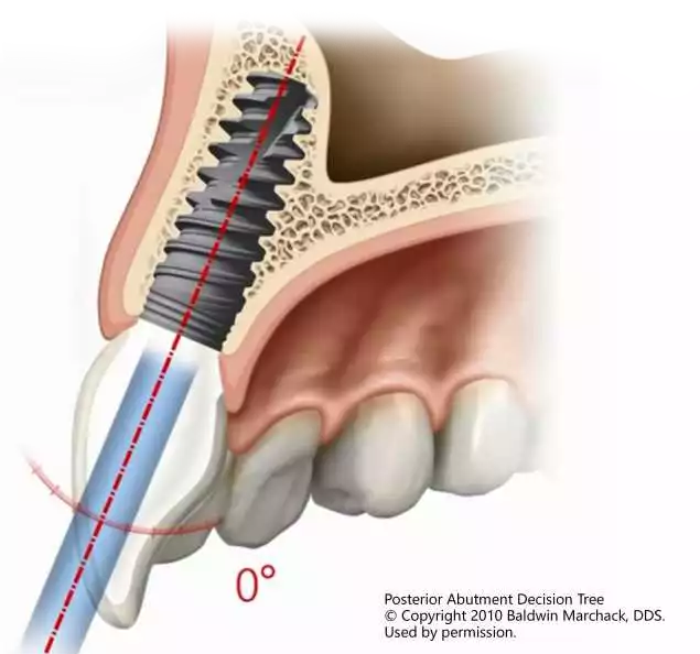 Dental Implants Implants Cost Auckland Implant Dentists