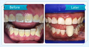 Jacky_Gum_Treatment