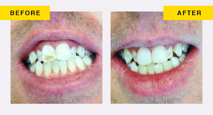 Enamel Hypoplasia Before And After